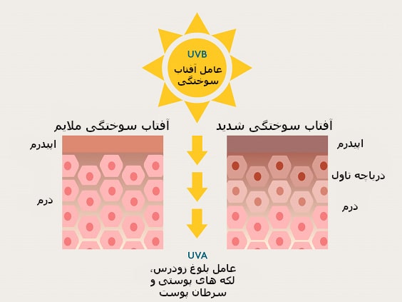 بیولوژی آفتاب سوختگی | خیز