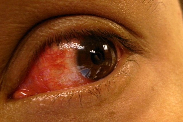 آرتریت پسوریاتیک قرمزی چشم | خیز