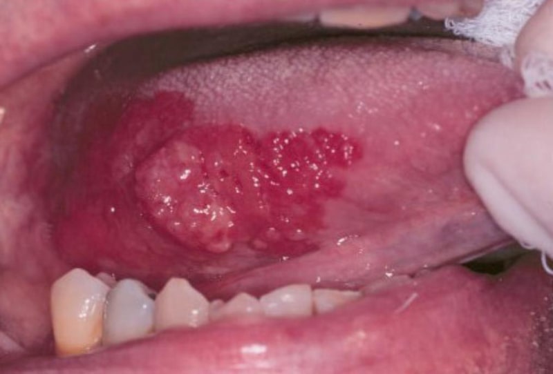 لکوپلاکیای دهانی قرمز | تونل ال ای دی جوانساز پوست